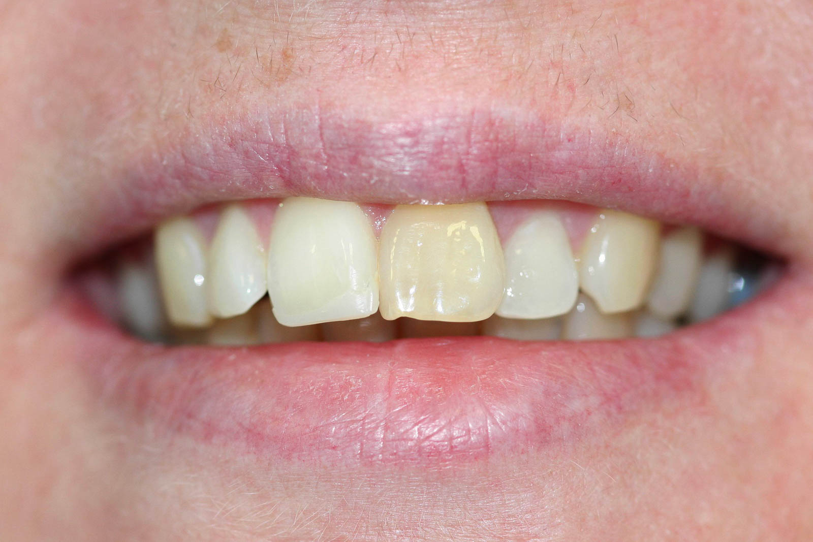 Whitening1A Whitening1A