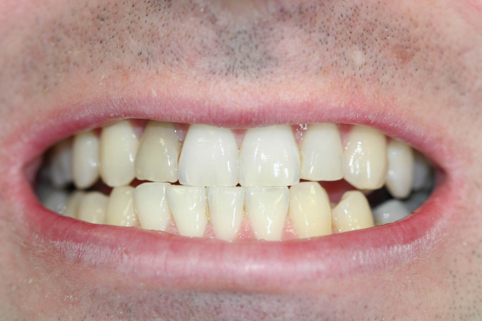 Whitening2A Whitening2A