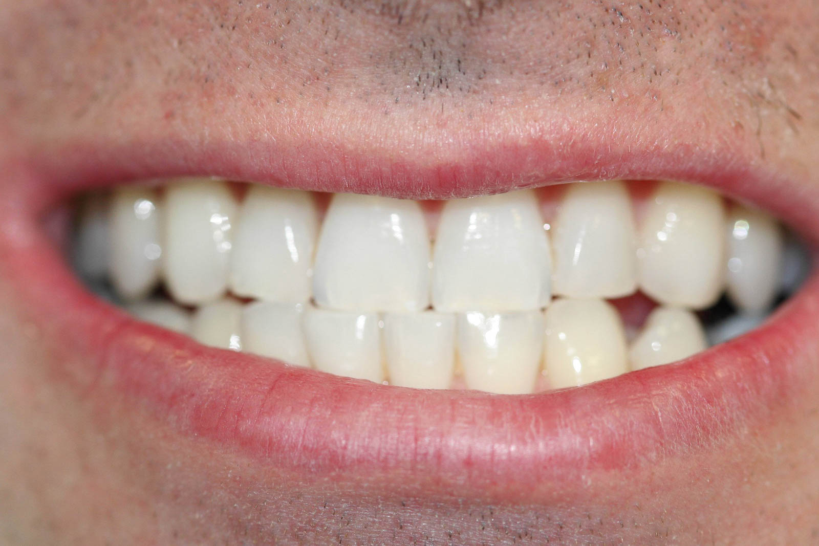 Whitening2B Whitening2B