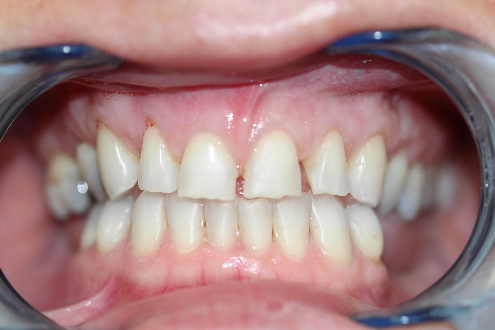 Veneers Before Veneers Before