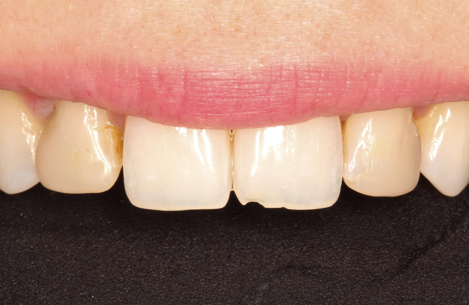 anterior white filling replacement before