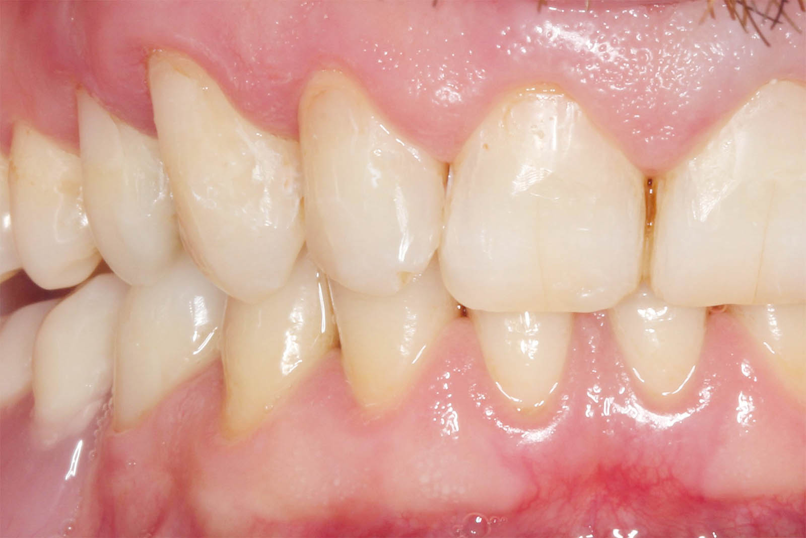 White Filling After