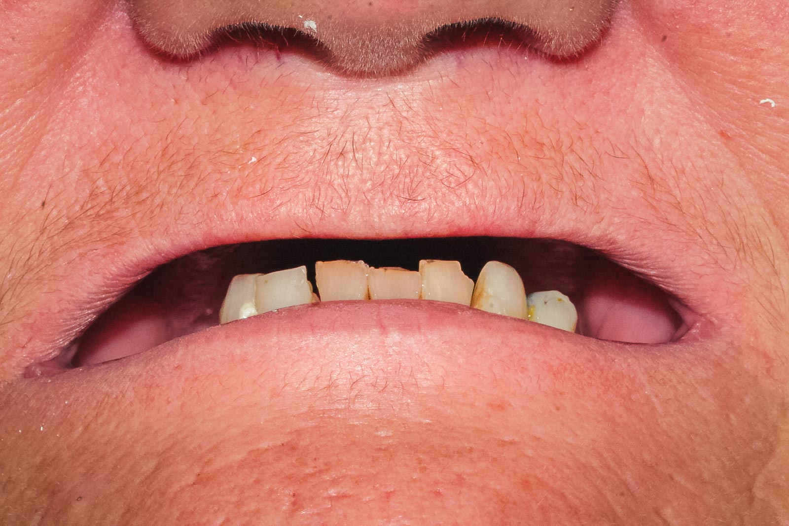 Before Dentures