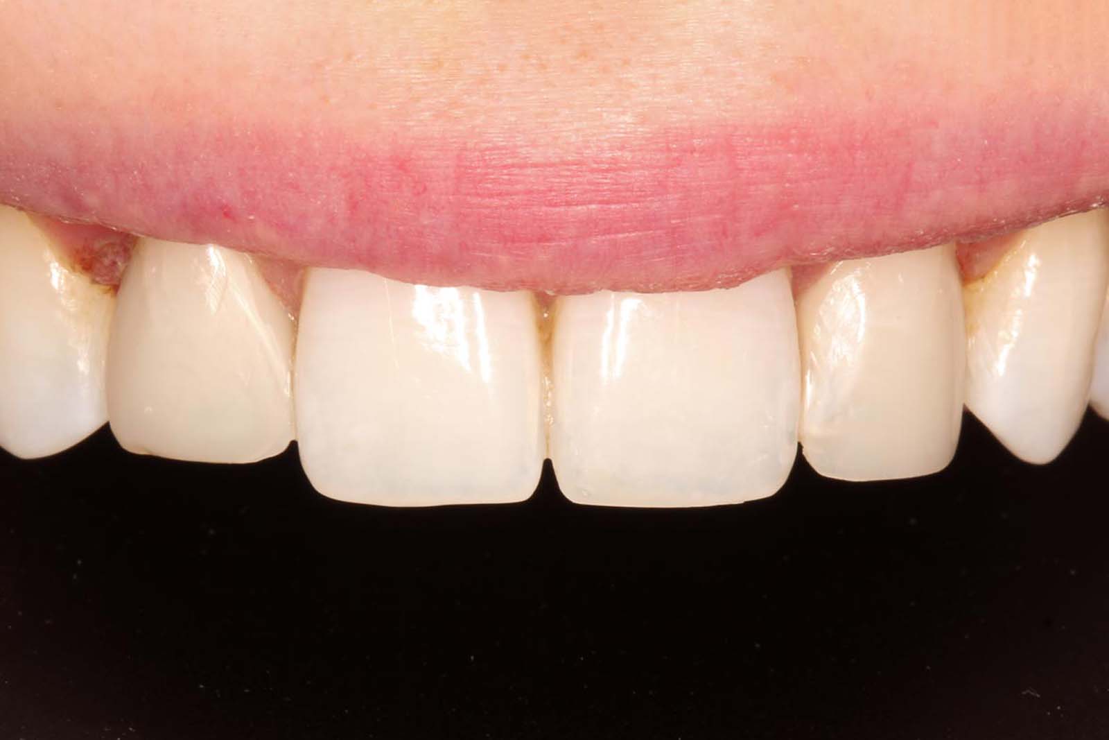 anterior white filling replacement after-b