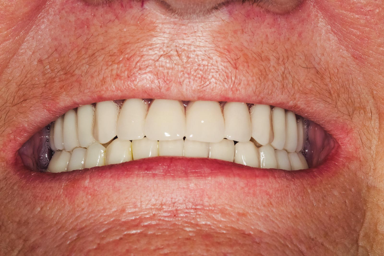 implant retained denture fit-WebSizeColour